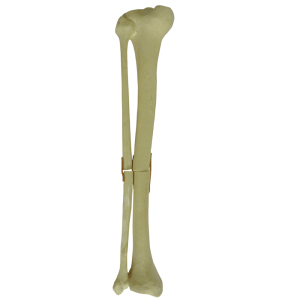 TÍBIA COM FÍBULA - FRATURA 1 - ESQUERDA - cód. 9700